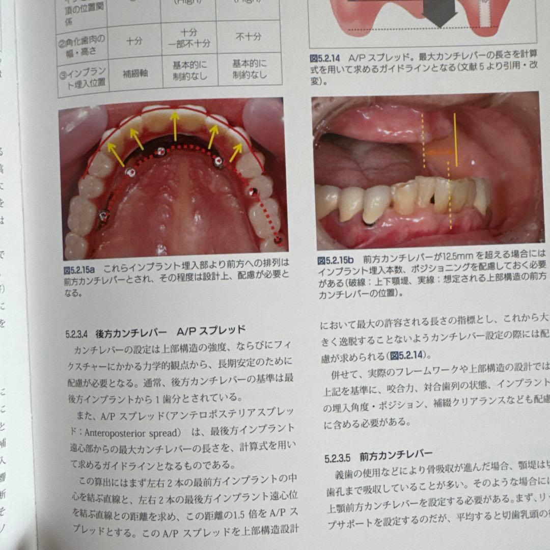 オーラルインプラント