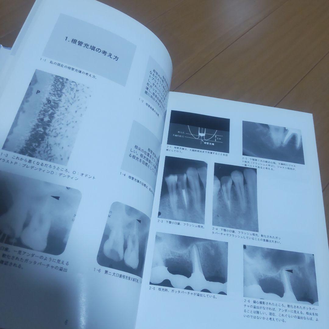 きがるな根管処置法   PARTー2