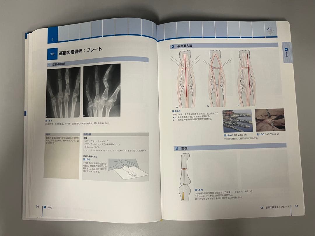 AO法 骨折治療 Hand and Wrist