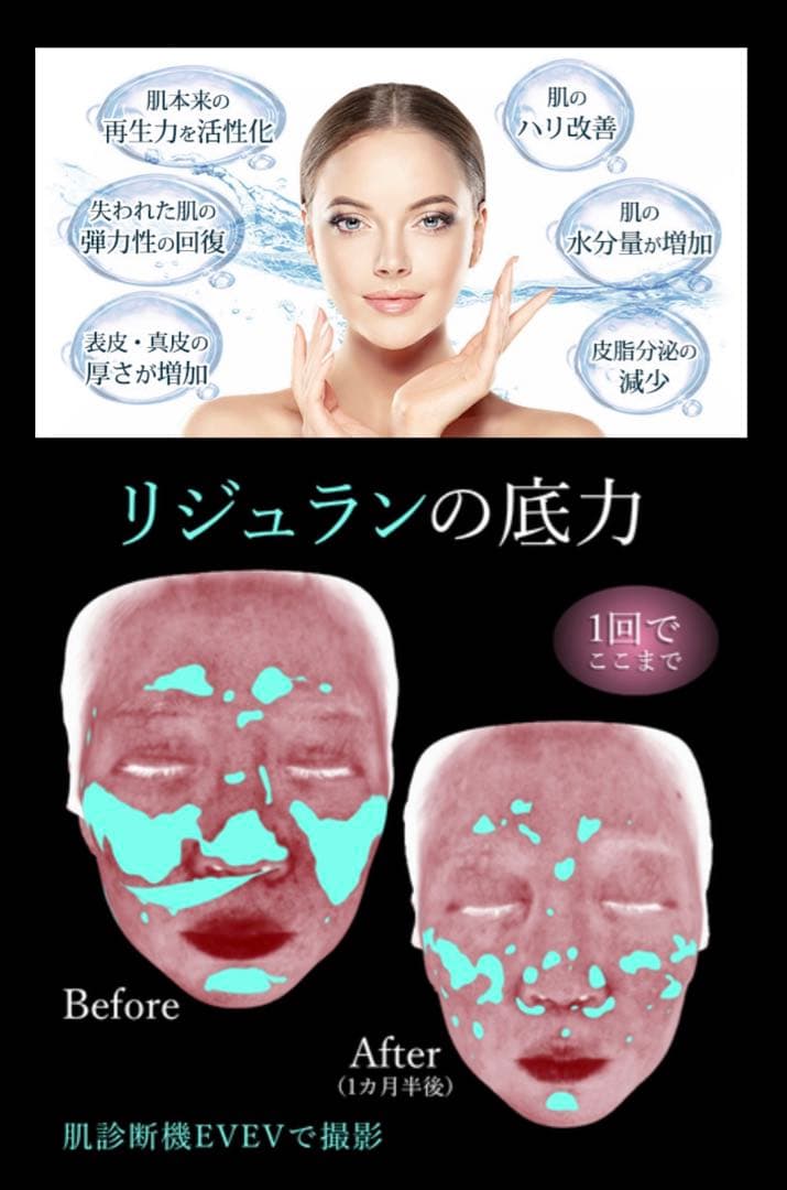kirakira　高純度リジュラン、ダーマローラー