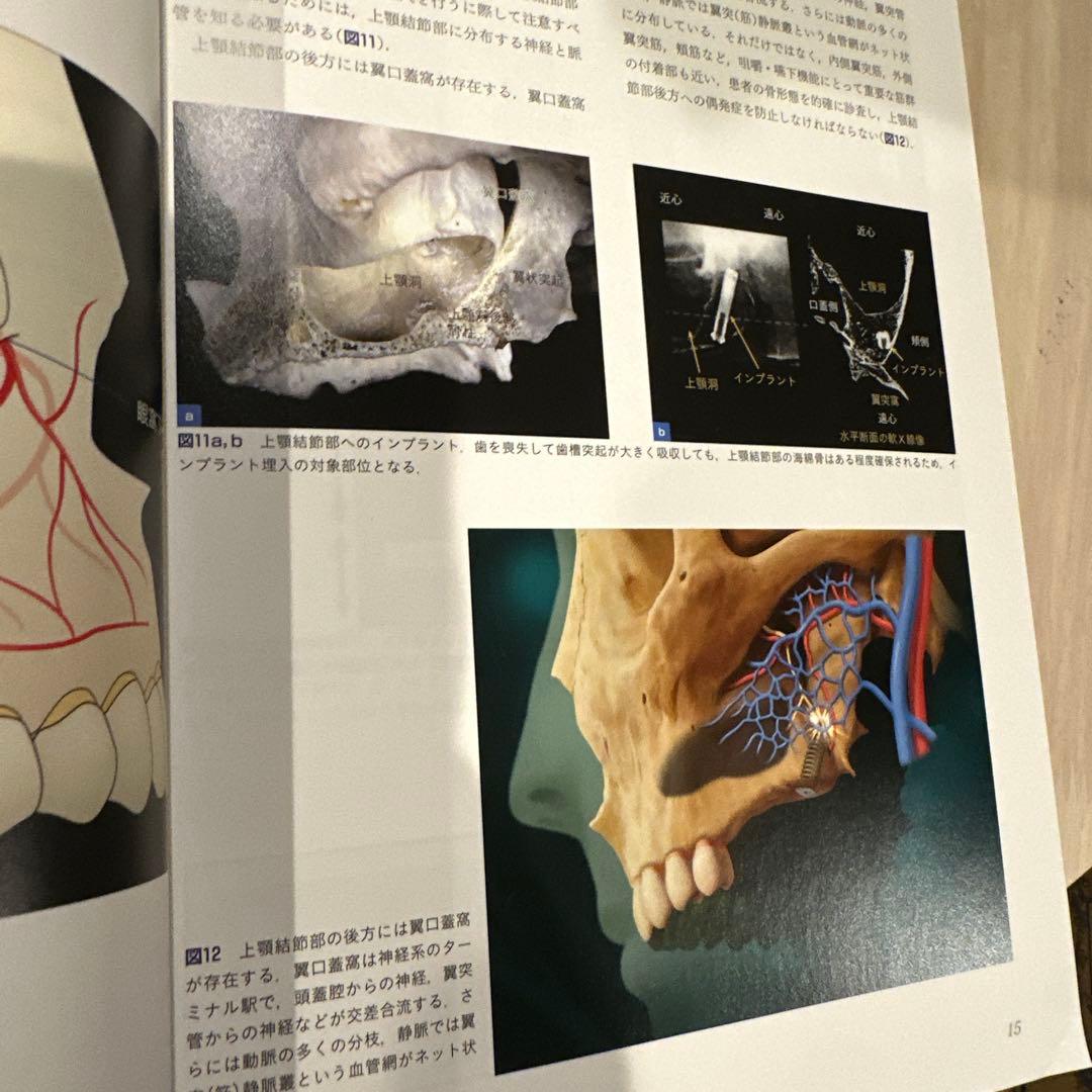 サイナスフロアエレベーションアルティメットガイド : 安全確実に上顎洞底拳上術…
