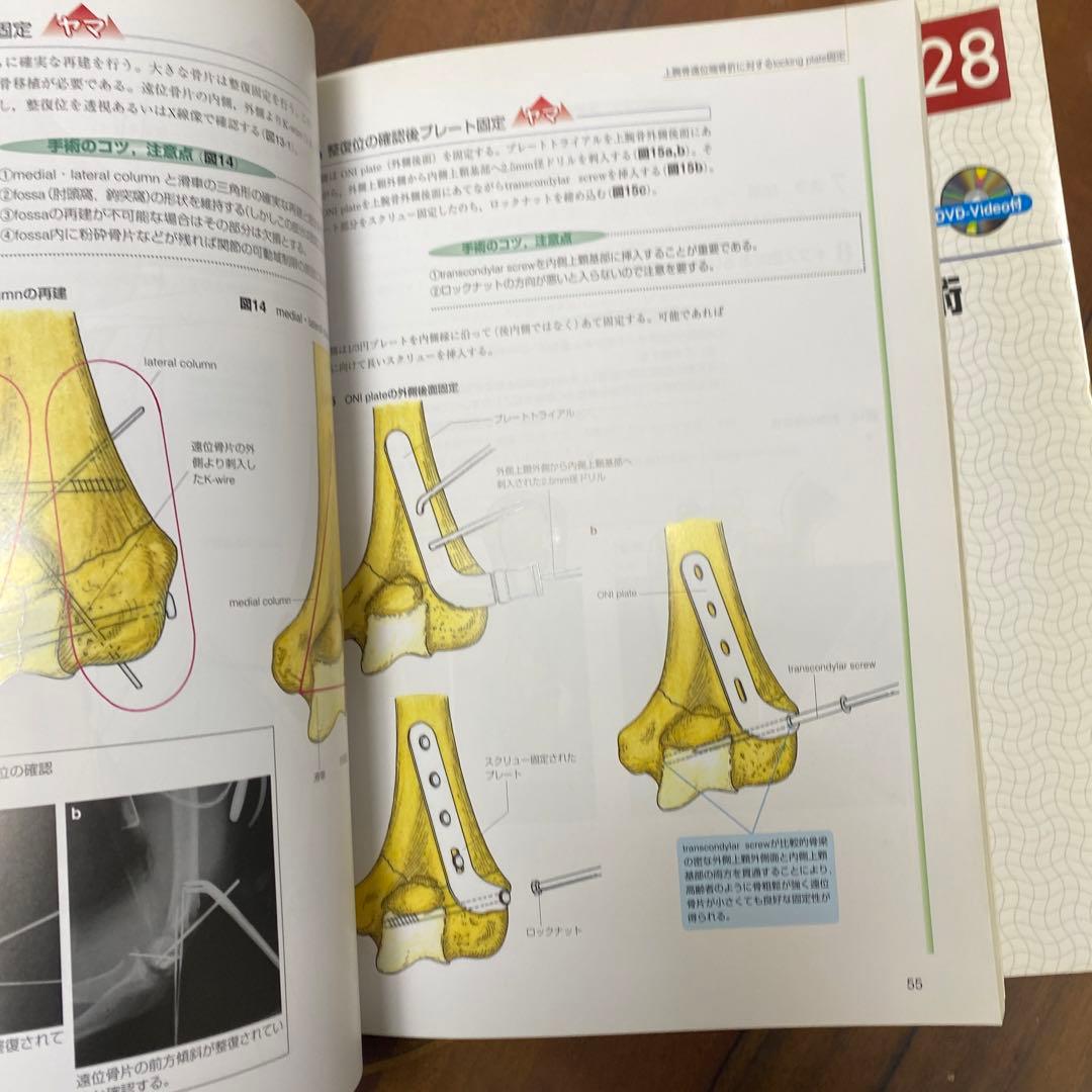 上肢の骨折・脱臼 : 手技のコツ&トラブルシューティング