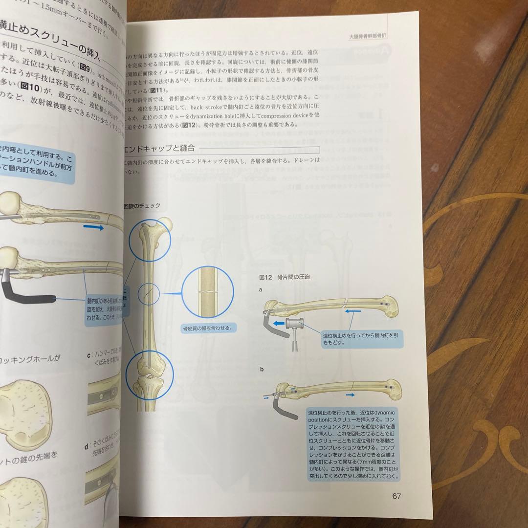 上肢の骨折・脱臼 : 手技のコツ&トラブルシューティング